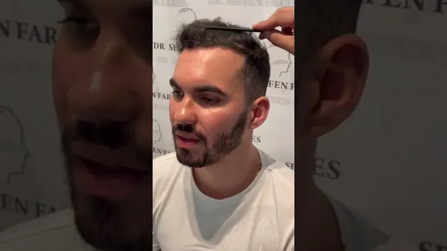 Greffe de cheveux — résultat à six mois