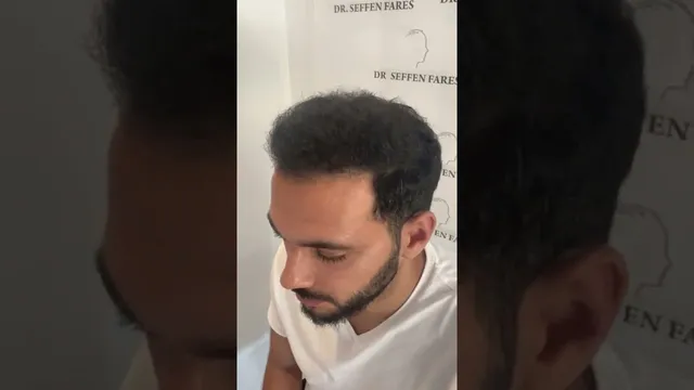 3 554 unités folliculaires, technique FUE / KEEP